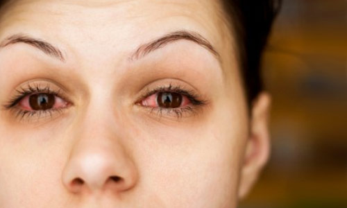 Sinus infection eyes new arrivals